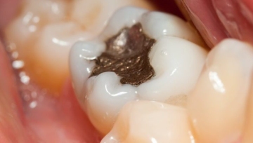 dental-filling